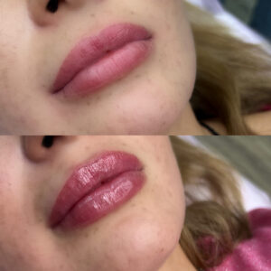 Injection cosmetology