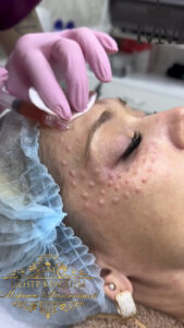 Injection cosmetology